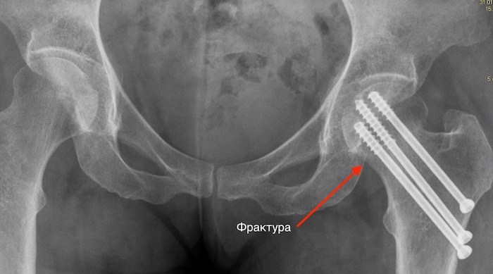 Фрактура на лявата бедрена шийка фиксирана с винтове